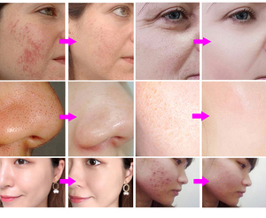 2025 più recente macchina per la microdermoabrasione idrodermoabrasione elettrica corea 15-In-1 - Product Image 3