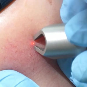 980nm Diodo Laser Máquina Aranha Veia Remoção Vascular UK Plug Desktop Modelo Pele Clareamento Apertando Face Lift Face Tratamentos - Product Image 6