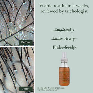 Traitement rapide du démangeaisons du cuir chevelu sec, spray hydratant pour le cuir chevelu, traitement rafraîchissant des démangeaisons du cuir chevelu pour les peaux sensibles et le <span class=keywords><strong>psoriasis</strong></span> - Product Image 3