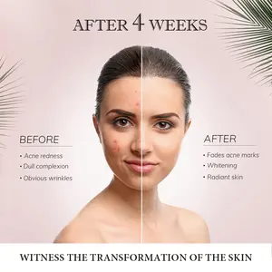 Etiqueta privada Cara Pecas Melasma Eliminación de imperfecciones Espinillas Crema para eliminar manchas oscuras Blanqueamiento DE LA PIEL Crema facial para eliminar manchas oscuras