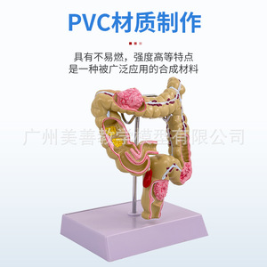 Modelo patológico de intestino grueso, modelo de intestino grueso, modelo gastrointestinal, modelo de enfermedades del colon humano, anatomía de lesiones - Product Image 1