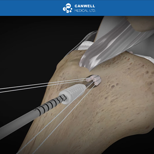 Sekrup Bioabsorpsi CANWELL ACL PLGA, Sekrup Interferensi untuk Rekonstruksi ACL/PCL, Operasi Artroskopi, Implan Ortopedi, Bersertifikasi CE - Product Image 4