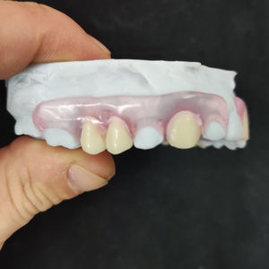 Riduzione minima dei denti miglior prezzo protesi flessibile <span class=keywords><strong>Valplast</strong></span> rimovibile con falsi denti acrilici artificiali - Product Image 4