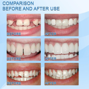 Colla per Denti Multiuso per Igiene Orale, Trucco Televisivo, Modifica di Protesi, Otturazioni Temporanee, Riempimento di Spazi tra i Denti - Product Image 4