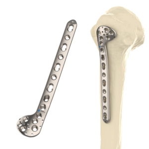 Placa de Bloqueo de Titanio para Húmero <span class=keywords><strong>Proximal</strong></span> CANWELL, Fabricante de Ortopedia de Compresión, Fábrica de Traumatología, OEM, Certificado CE - Product Image 1