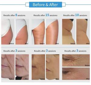 Feier 2in 1 360-Grad-Innenkugelmassagegerät Stehender Körper Abnehmen Ball Cellulite Reduction Tool Lymphatische Endos Hotsell X50 - Product Image 6