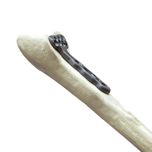 Système de plaque de verrouillage à angle variable CANWELL en titane pour implants orthopédiques traumatiques, pour la fixation des fractures du <span class=keywords><strong>radius</strong></span> distal volar AO - Product Image 2