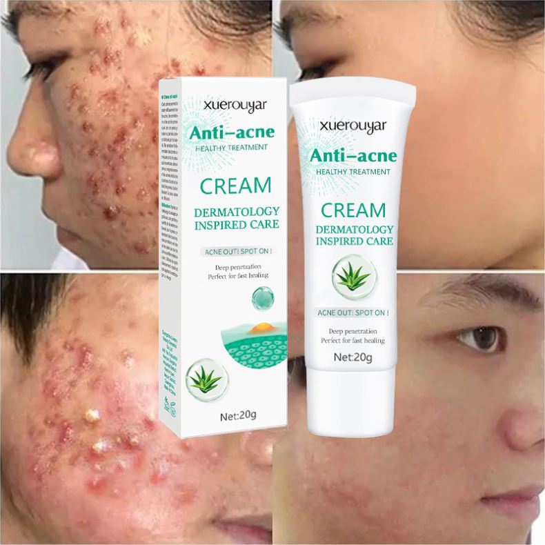 Skin Care Repair Face Pimples Acne Smooth Skin Shrink Pores Skin Moisturizer Gentle Anti Acne Whitening aloe vera acne cream