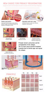 Pulsed CO2 Fractional Laser <strong>Removal</strong> <strong>Cream</strong> with ABS Material for Body <strong>Warts</strong> Condyloma Acuminatum Acne Scars Freckles RF Treatment - Product Image 4