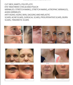 อุปกรณ์ความงามแบบ Fractional สำหรับการยกกระชับใบหน้า ช่วยปรับปรุงผิวหมองคล้ำและซีดจาง ผลิตโดยโรงงานโดยตรง - Product Image 4