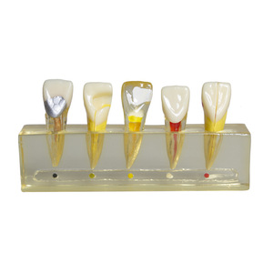 Modelo de Pulpa Dental Anterior con Pulpitis, Modelo de Enseñanza Dental Clínico Patológico, Equipo y Accesorios - Product Image 4