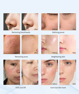 Appareil professionnel Hydra Spa Oxygène Jet Hydro-Dermabrasion 2026 pour soins du visage en salon, hydratation de la peau, usage commercial - Product Image 5