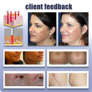 Fractional CO2 Laser 70 Wát mụn sẹo loại bỏ da tái tạo bề mặt loại bỏ nếp nhăn fractional CO2 máy laser da liễu thiết bị - Product Image 6