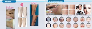 2 Trong 1 Ba Bước Sóng 755nm 808nm 1064nm Diode Laser Hair Removal Máy Và ND Yag Tattoo Removal Đa Chức Năng Vẻ Đẹp - Product Image 3