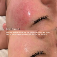 Gel apaisant et rafraîchissant pour la peau après traitement, pour le visage, soulagement des démangeaisons, réparation de la barrière cutanée, hydratant, soin apaisant pour peaux sensibles