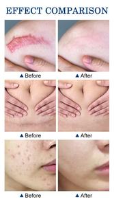 Etkili skar kaldırma yüz kremi akne sivilce streç işaretleri kaldırmak jel yumuşatma sıkılaştırıcı Anti streç işaretleri skar onarım krem - Product Image 4