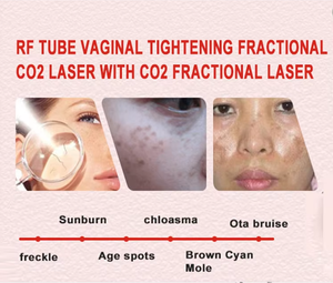 เครื่องตัดเลเซอร์ CO2 แบบพกพาสำหรับเดสก์ท็อป กำจัดรอยแผลเป็นบนใบหน้า ฟื้นฟูผิว ลดเลือนริ้วรอย กระชับผิว - Product Image 5