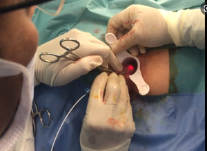 Minimaal Invasieve Colorectale Hemorrhoidectomy Hemorrhoidoplasty Fistel <span class=keywords><strong>Laser</strong></span> Sluiting Proctology Chirurg <span class=keywords><strong>Laser</strong></span> - Product Image 4