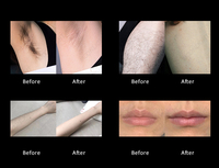 Machine professionnelle d'épilation au laser diode, sans douleur, 755/808/940/1064, utilisation en salon de beauté, équipement d'épilation au laser diode