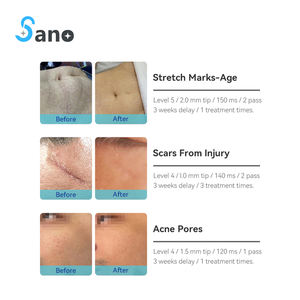 Appareil de <span class=keywords><strong>radiofréquence</strong></span> <span class=keywords><strong>à</strong></span> <span class=keywords><strong>micro</strong></span>-<span class=keywords><strong>aiguilles</strong></span> 2-en-1 haute fréquence pour le raffermissement cutané et l'élimination des cicatrices d'acné, compatible avec les prises EU/UK - Product Image 6