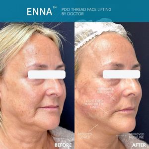 Coréia colágeno fio dourado face lift colágeno tensão tópicos - Product Image 6