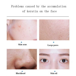 Meilleure Vente : Appareil de Microdermabrasion et Hydrodermabrasion 9-en-1 FaceDiamond pour l'élimination des points noirs - Product Image 5