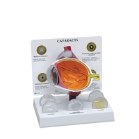 Ojo médico humano agrandado, modelo de ojo de catarata, modelo anatómico de ojo, modelo de glaucoma