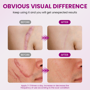 <span class=keywords><strong>ครีม</strong></span>บำรุงผิวหน้าต่อต้านริ้วรอยด้วยกรดไฮยาลูโรนิก เชียบัตเตอร์ และกรดแลคโตไบโอนิก สำหรับ<span class=keywords><strong>ลด</strong></span><span class=keywords><strong>รอย</strong></span>แผลเป็นจาก<span class=keywords><strong>สิว</strong></span>และ<span class=keywords><strong>รอย</strong></span>แตกลาย - Product Image 6