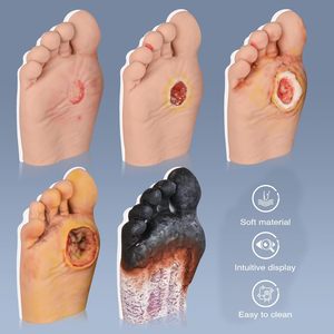 Mannequin <span class=keywords><strong>de</strong></span> formation médicale pour pied diabétique, 5 pièces, taille humaine, en PVC, origine Henan, marque Yulin, niveaux 1-5, pour écoles - Product Image 4