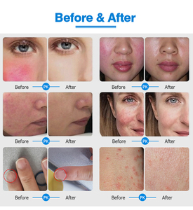 Máquina de Diodo Ce Taibo 5 <span class=keywords><strong>en</strong></span> 1 para Eliminación de Vasos Sanguíneos, Hongos <span class=keywords><strong>en</strong></span> las Uñas, Eliminación Vascular de 980nm, Eliminación de Arañas Vasculares, Limpieza Facial de Venas y Eliminación de Capilares - Product Image 6