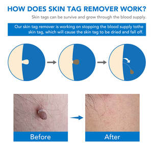 세푸둔 2mm~7mm 스킨 워트 제거 펜 스킨 태그 제거 키트 빅 헤드 스킨 태그 리무버 워트 제거 자동 스킨 태그 제거 키트 - Product Image 4