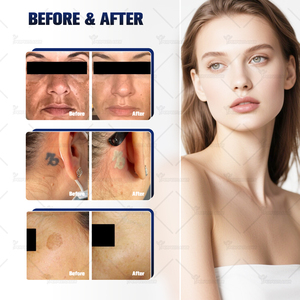 2025 Offre Spéciale <span class=keywords><strong>4</strong></span> longueur d'onde picoseconde Laser Tattoo Removal Machine Nd Yag 532nm 755nm 1064nm 1320nm <span class=keywords><strong>Pico</strong></span> Laser <span class=keywords><strong>Prix</strong></span> - Product Image 6