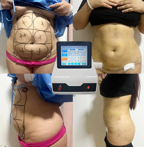 Máquina <span class=keywords><strong>de</strong></span> Lifting Facial Endoláser 2026 para <span class=keywords><strong>Papada</strong></span>, Levantamiento <span class=keywords><strong>de</strong></span> Cuello y Bolsas <span class=keywords><strong>de</strong></span> Ojos con Láser <span class=keywords><strong>de</strong></span> Fibra 980 1470nm - Product Image 2