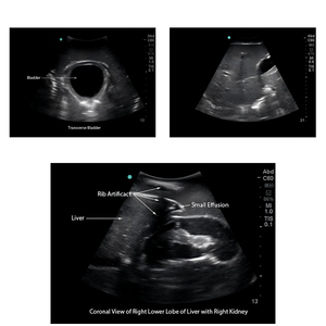 Módulo de Patología para Ultrasonido: Pacote de Insertos Reemplazables para Neumotórax, AAT, Cirrosis, Cálculos Biliares y Cálculos Renales para Modelos de Entrenamiento - Product Image 5