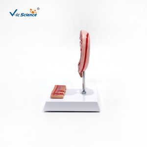 Modèle d'ulcère gastrique et de perforation : Montre l'évolution de la gastrite à l'ulcère perforant pour l'enseignement médical et la formation en pathologie - Product Image 4