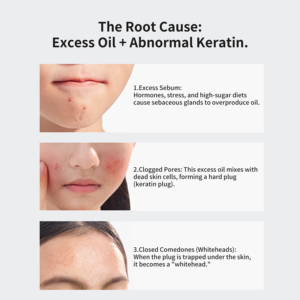 Teen tì vết-Kiểm soát thanh lọc huyết thanh-hibisclear Roselle axit bản chất cho da nhờn mụn đầu trắng & mụn đầu đen loại bỏ - Product Image 3