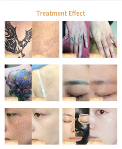 Appareil professionnel de suppression de tatouages par picoseconde et d'épilation IPL – Équipement de beauté professionnel pour le blanchiment de la peau 1064nm 532nm - Product Image 6