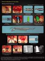 Kit chirurgical Osstem universel de haute qualité pièce à main dentaire équipement en acier inoxydable restauration d'implant boîte à outils conique