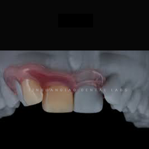 Laboratorio dentale restauro orale protesi dentarie rimovibili denti acrilici flessibili Valplast prodotti dentali senza metallo - Product Image 4