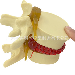 Simulation pédagogique du modèle de hernie discale lombaire humaine, démonstration de mesure de la pression vertébrale, vertébral - Product Image 5