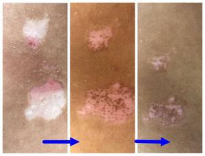 KN-4006BL di grado medico 311nm a banda stretta UVB fototerapia portatile UVB terapia della luce per la psoriasi attrezzatura di terapia fisica - Product Image 6