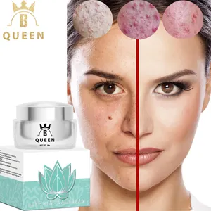 Remove Acne Pimple Marks Cream For Anti Freckle Acne Clear Skin Spots Removal Cream