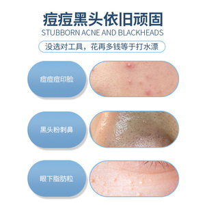 Aiguille anti-acné multifonctionnelle avec pointe ultra-affûtée et poignée antidérapante ; un outil de beauté pour le visage, idéal pour éliminer les points noirs et l'acné. - Product Image 1