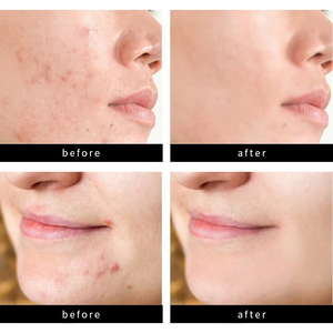 Oem mặt nhược điểm da Hydrocolloid mụn vá tùy chỉnh nhãn hiệu riêng mặt trang điểm tự nhiên bao gồm zits vá nhà máy bán buôn - Product Image 6