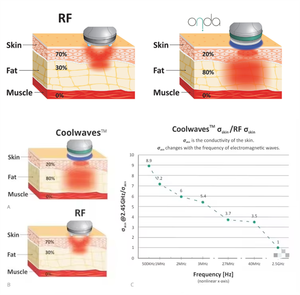 Mesin Pereduksi Selulit Microwave Vakum Coolwaves Pocket Face Ondapro 4 Handle 2.45ghz - Product Image 4