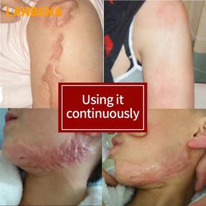 Crème à base de plantes LANBENA pour une élimination rapide et <span class=keywords><strong>efficace</strong></span> des cicatrices et des vergetures, réparation de la peau, lotion pour le visage - Product Image 5