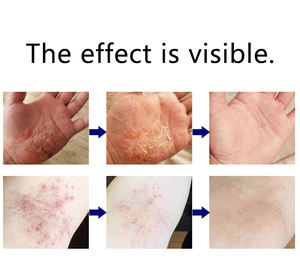 Krim gatal pelembap eksim, Krim Psoriasis anti pruritik cepat efektif, salep untuk Dermatitis dewasa - Product Image 6