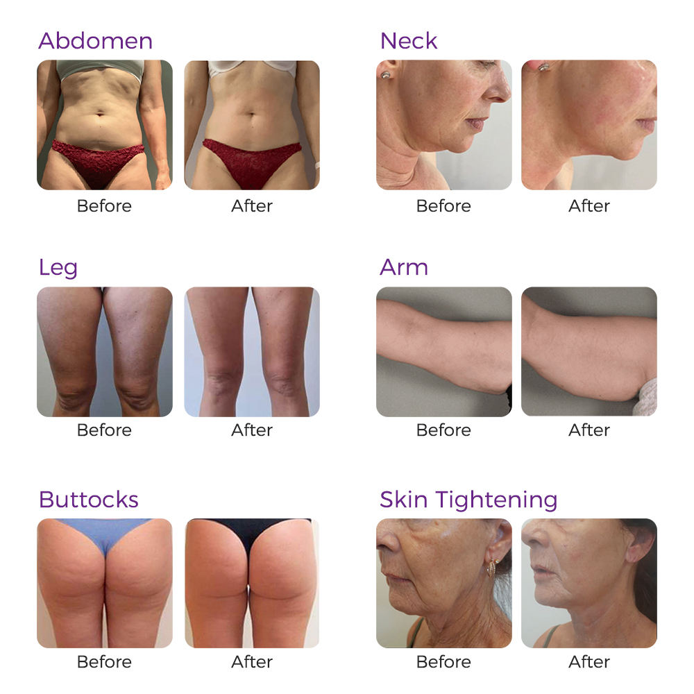 ORANGLES Newangie Inner Ball Roller Slimming Machine | 3-Mode Commercial Massager for Body Contouring & Weight Loss – orangles Qatar - detailed closeup view - illustrating benefits - Image 3 of 6 | created for all | Shop Newangie Inner Ball Roller Slimming Machine | 3-Mode Commercial Massager for Body Contouring & Weight Loss – orangles Qatar North Carolina | Free Shipping ORANGLES