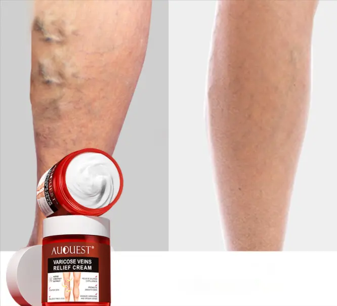 Spataderen Relief Crème Vasculitis Phlebitis Spider Pijnbestrijding Zalf Medische Gips Lichaamsverzorging 80G