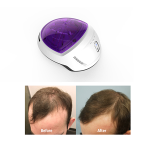 Casque de thérapie par lumière rouge de qualité médicale 650 nm approuvé aux États-Unis pour la repousse des cheveux, à usage domestique - Product Image 5